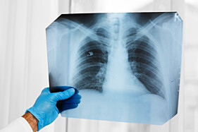 ANGIOTOMOGRAFIA VENOSA PULMONAR