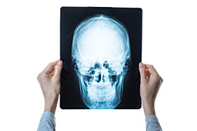 RADIOGRAFIA SEIOS DA FACE