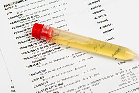 EXAME DE URINA  (EAS - Elementos Anormais do Sedimento)